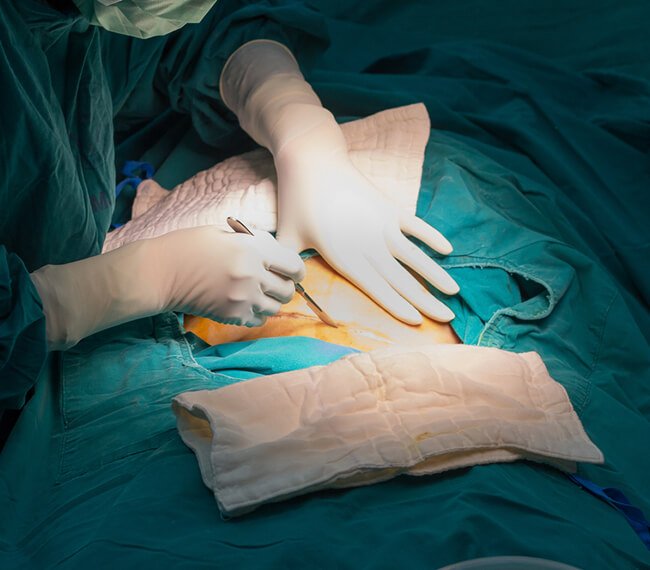 Cesarean Delivery