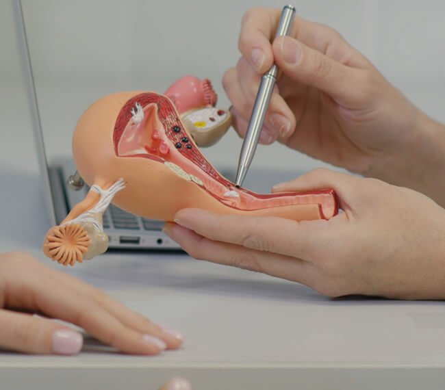 Laparoscopic Hysterectomy 4