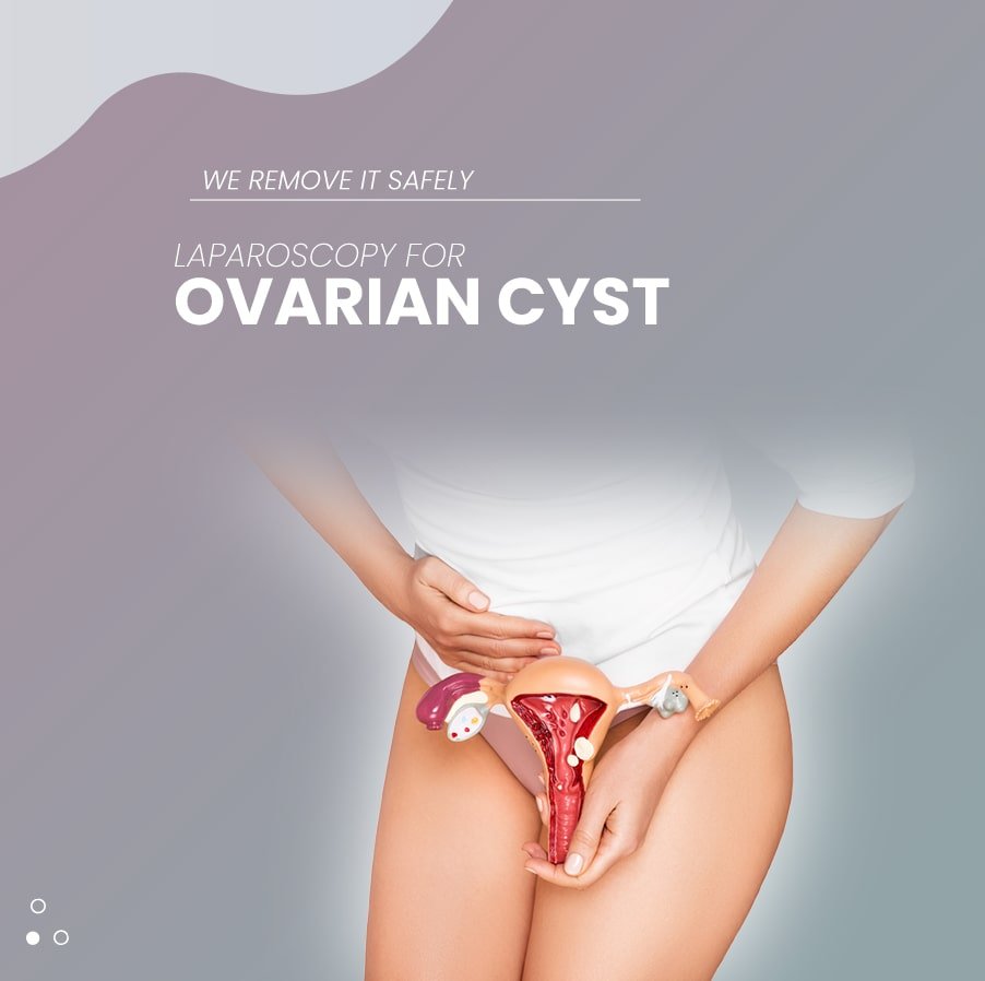 Laparoscopy for Ovarian Cyst min