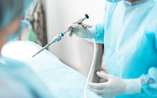 Laparoscopy for infertility