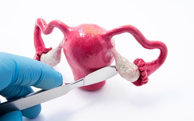 Laparoscopy for ovarian cysts 2