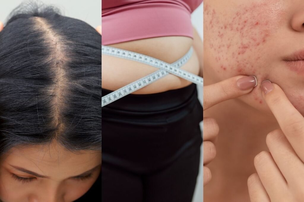 PCOS (polystic ovary syndrome)