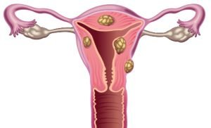 Uterine Fibroids