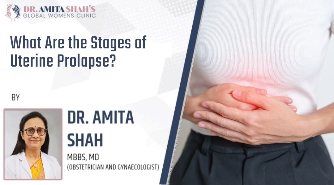 What Are the Stages of Uterine Prolapse