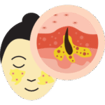 Acne and oily<br>skin